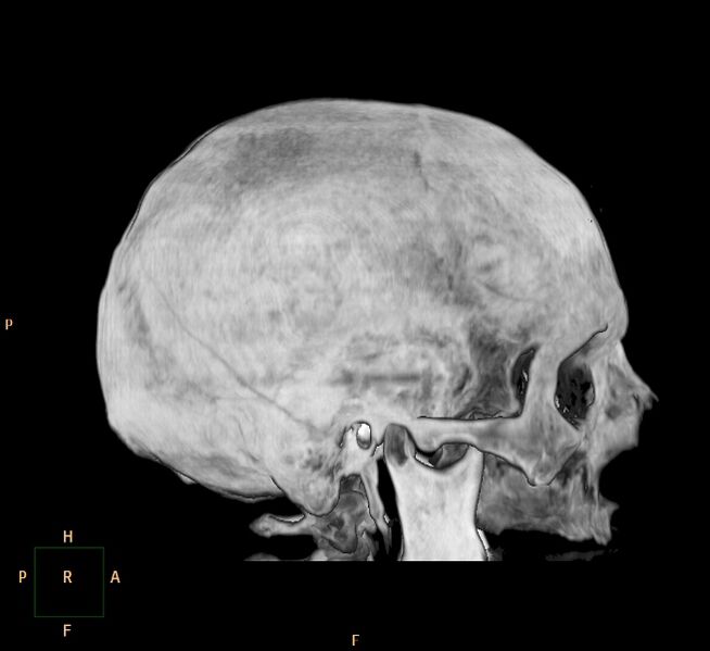 File:Cerebral hemorrhagic contusions (Radiopaedia 23145-23188 3D MIP 6).jpg