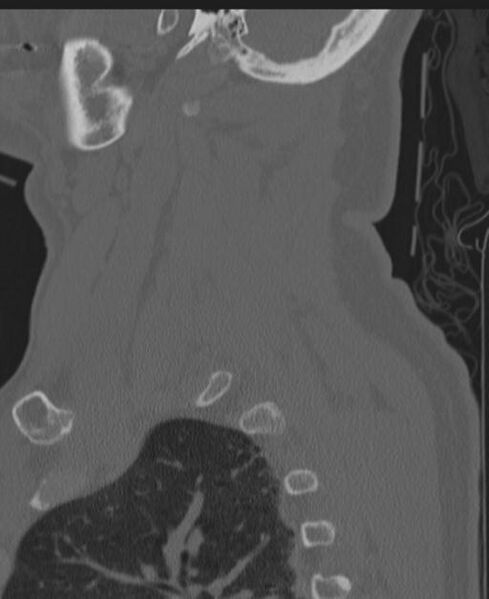 File:Cerebral hemorrhagic contusions and cervical spine fractures (Radiopaedia 32865-33841 Sagittal bone window 80).jpg