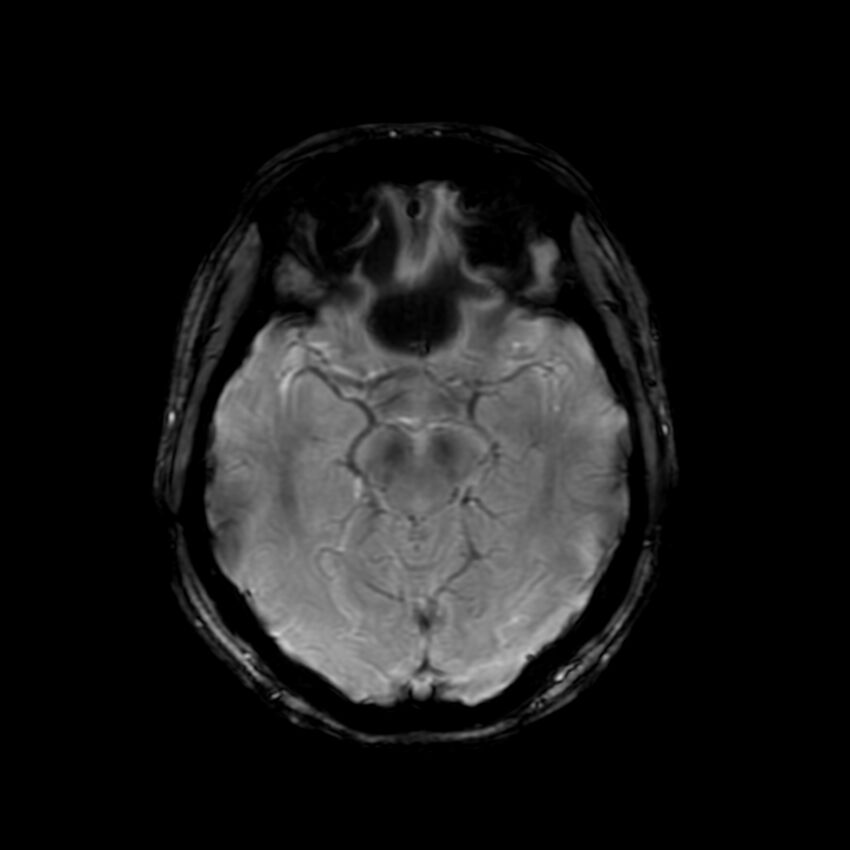 Cerebral paragonimiasis (Radiopaedia 73473-84238 Axial SWI 28).jpg