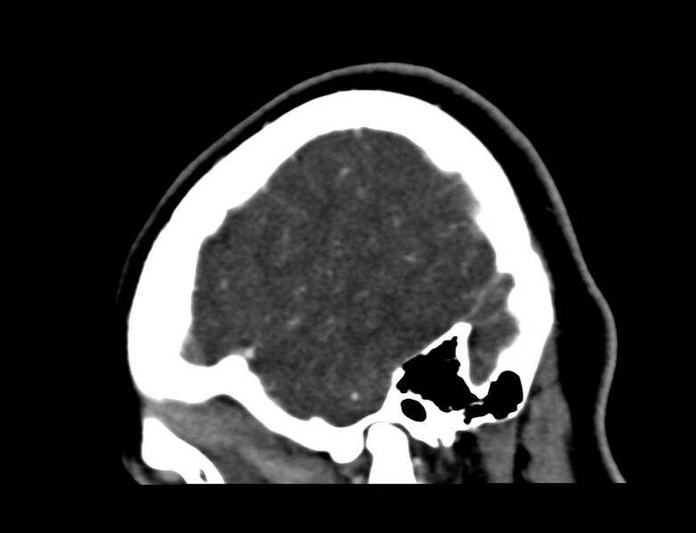 File:Cerebral venous sinus thrombosis (Radiopaedia 59224-66646 Sagittal C+ delayed 61).jpg