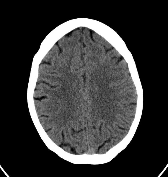File:Cerebral venous thrombosis - CT only (Radiopaedia 41031-43778 Axial non-contrast 24).jpg