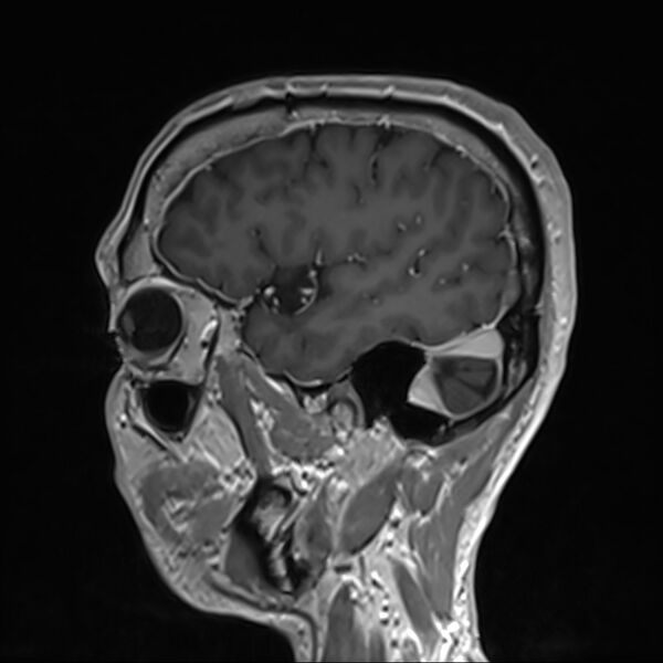File:Cervical dural CSF leak on MRI and CT treated by blood patch (Radiopaedia 49748-54995 G 14).jpg