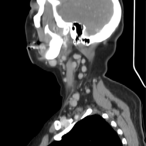 File:Cervical lymphadenopathy- cause unknown (Radiopaedia 22420-22457 D 7).jpg