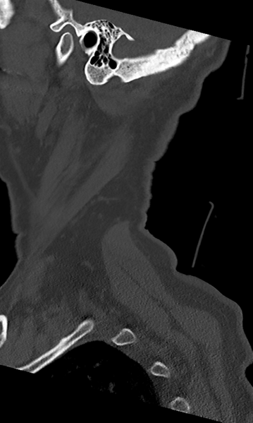File:Cervical spine fracture - chalk stick (Radiopaedia 39116-41323 Sagittal bone window 58).png