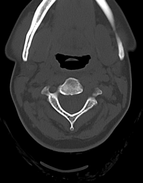 File:Cervical tuberculous spondylitis (Radiopaedia 39149-41365 Axial bone window 18).png