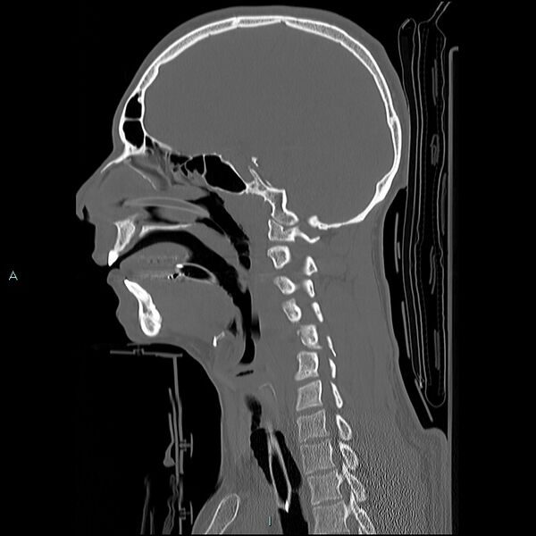File:Cervical vertebral burst fracture (Radiopaedia 37420-39258 Sagittal bone window 20).jpg
