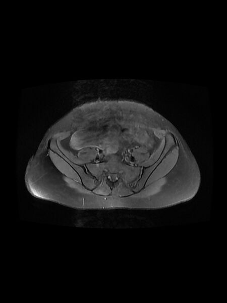 File:Cesarean section scar endometrioma (Radiopaedia 56569-63297 Axial PD fat sat 10).jpg