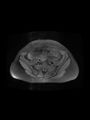 Cesarean section scar endometrioma (Radiopaedia 56569-63297 Axial PD fat sat 10).jpg