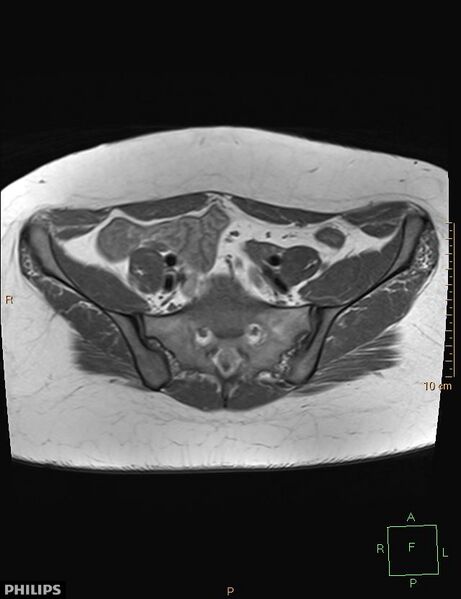 File:Cesarian scar endometriosis (Radiopaedia 68495-78066 Axial T1 3).jpg