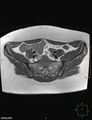 Cesarian scar endometriosis (Radiopaedia 68495-78066 Axial T1 3).jpg