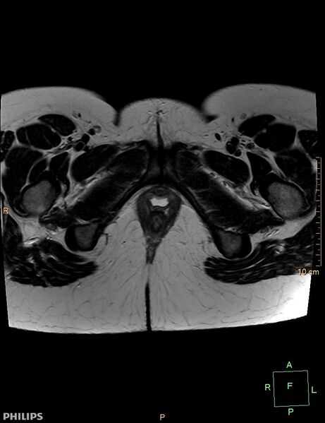 File:Cesarian scar endometriosis (Radiopaedia 68495-78066 Axial T2 26).jpg