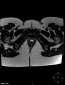 Cesarian scar endometriosis (Radiopaedia 68495-78066 Axial T2 26).jpg