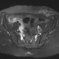 Cesarian section scar endometriosis (Radiopaedia 66520-75799 Axial T2 fat sat 6).jpg