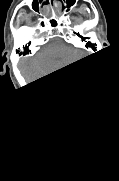 File:Chalk stick fracture (Radiopaedia 57948-64928 Axial non-contrast 3).png