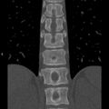 Chance fracture (Radiopaedia 36521-38081 Coronal bone window 30).jpg