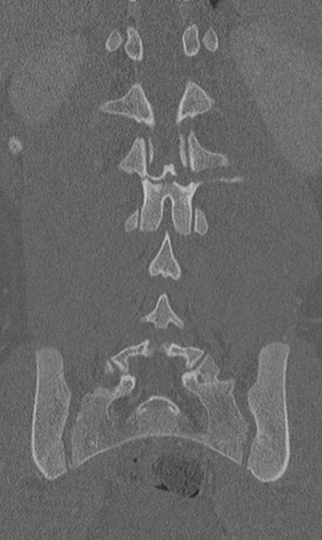 File:Chance fracture (Radiopaedia 40360-42912 Coronal bone window 48).png