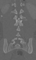 Chance fracture (Radiopaedia 40360-42912 Coronal bone window 48).png