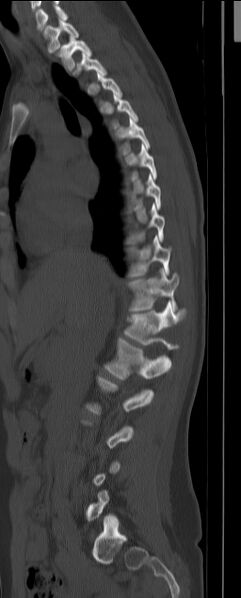 File:Chance fracture (Radiopaedia 45345-49372 Sagittal bone window 6).jpg