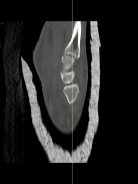 File:Chauffeur's (Hutchinson) fracture (Radiopaedia 58043-65079 Sagittal bone window 14).jpg