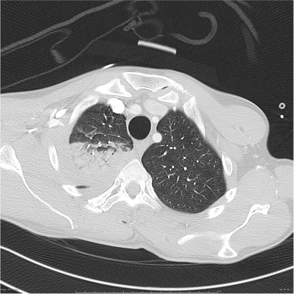 File:Chest and abdomen multi-trauma (Radiopaedia 26294-26425 lung window 26).jpg