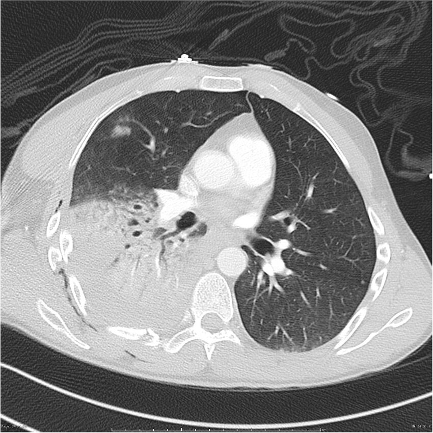 Chest and abdomen multi-trauma (Radiopaedia 26294-26425 lung window 54).jpg