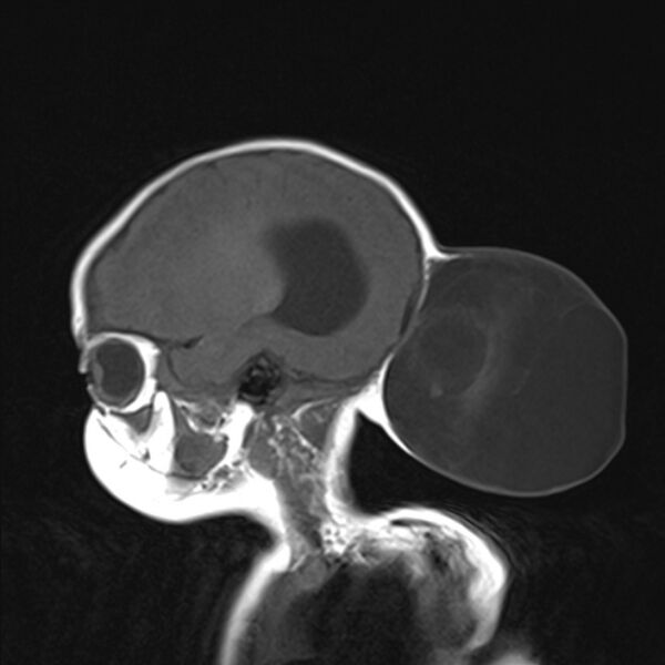 File:Chiari III malformation with occipital encephalocele (Radiopaedia 79446-92559 Sagittal T1 16).jpg
