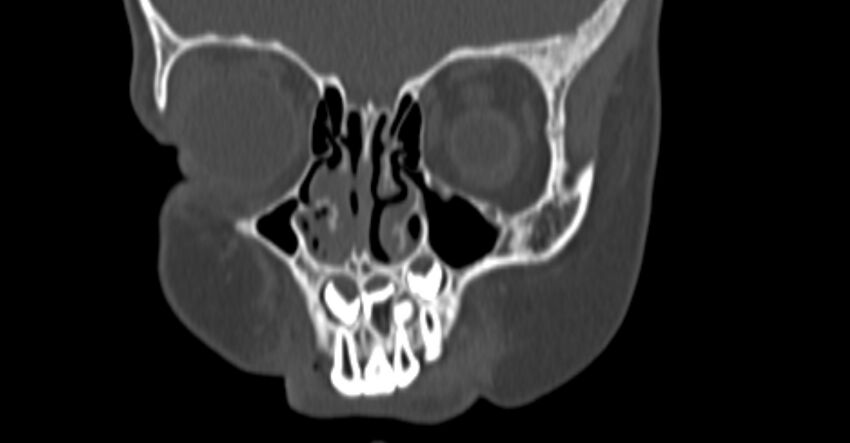 Choanal atresia (Radiopaedia 51295-56972 Coronal bone window 14).jpg