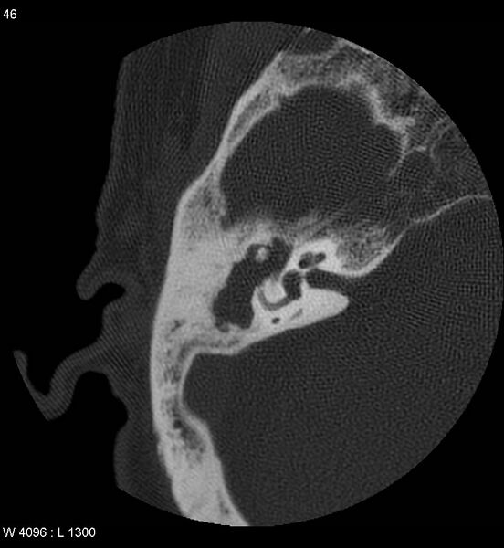 File:Cholesteatoma (Radiopaedia 5467-7197 Axial bone window 6).jpg