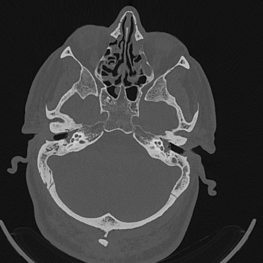 Cholesteatoma (Radiopaedia 68176-77673 Axial bone window 38).jpg