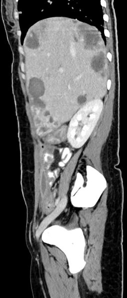 File:Choriocarcinoma liver metastases (Radiopaedia 74768-85766 C 125).jpg