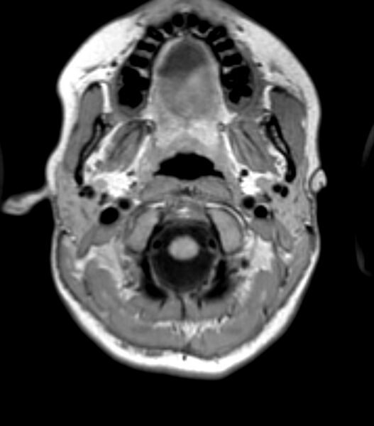 File:Choroid plexus carcinoma (Radiopaedia 91013-108553 Axial T1 25).jpg