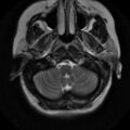 Choroid plexus xanthogranuloma (Radiopaedia 17650-17386 T2 22).jpg