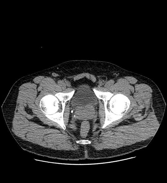 File:Chromophobe renal cell carcinoma (Radiopaedia 84337-99693 Axial non-contrast 155).jpg