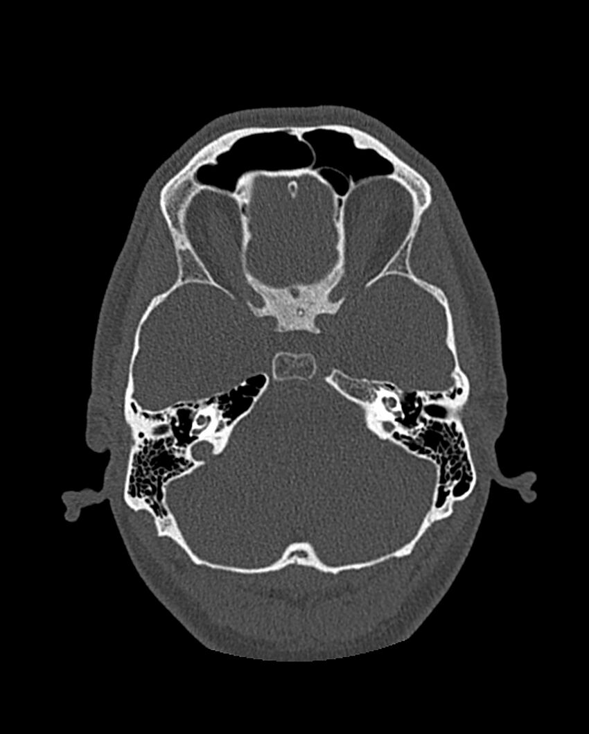 Chronic maxillary sinusitis caused by a foreign body (Radiopaedia 58521-65676 Axial bone window 247).jpg
