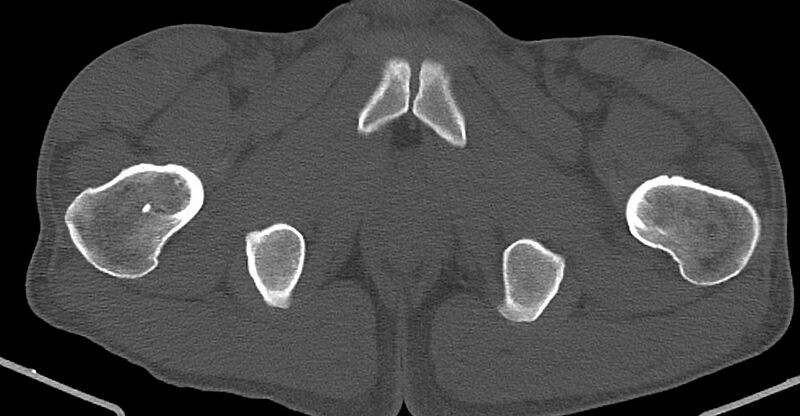 File:Chronic osteomyelitis (with sequestrum) (Radiopaedia 74813-85822 Axial non-contrast 49).jpg