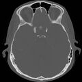 Chronic otomastoiditis (Radiopaedia 27138-27309 Axial bone window 52).jpg