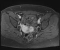 Class II Mullerian duct anomaly- unicornuate uterus with rudimentary horn and non-communicating cavity (Radiopaedia 39441-41755 Axial T1 fat sat 72).jpg