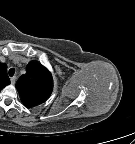 File:Clear cell chondrosarcoma - humerus (Radiopaedia 63104-71612 Axial non-contrast 41).jpg
