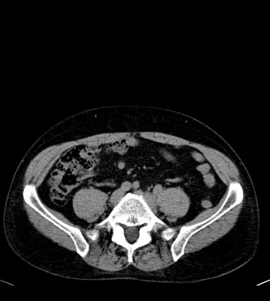File:Clear cell renal cell carcinoma (Radiopaedia 85006-100539 Axial non-contrast 61).jpg