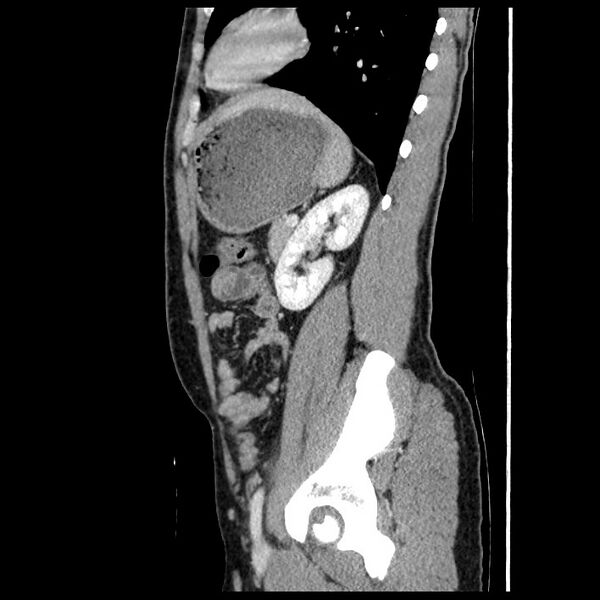 File:Co-existing acute appendicitis and epiploic appendagitis (Radiopaedia 61789-69911 B 69).jpg