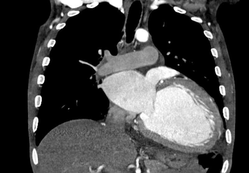 File:Coarctation of aorta with aortic valve stenosis (Radiopaedia 70463-80574 C 111).jpg