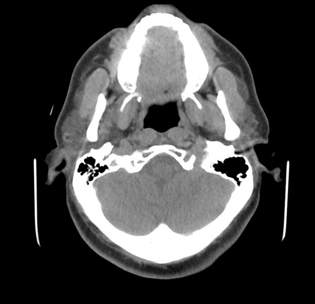 File:Colloid cyst of thyroid (Radiopaedia 22897-22923 Axial non-contrast 9).jpg