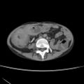 Colocolic fistula - Crohn disease (Radiopaedia 57063-63955 A 49).jpg