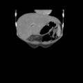 Colocolic fistula - Crohn disease (Radiopaedia 57063-63955 B 5).jpg