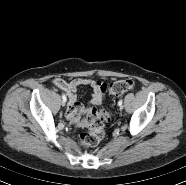 File:Colon carcinoma with hepatic metastases (Radiopaedia 29477-29961 A 97).jpg
