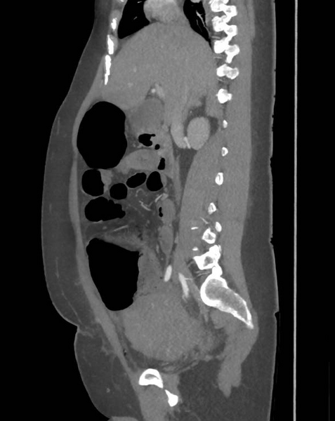 File:Colonic pseudo-obstruction (Radiopaedia 79752-92980 C 33).png