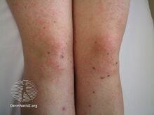 Enteroviral infetion rash (DermNet NZ enteroviral-rash-027).jpg