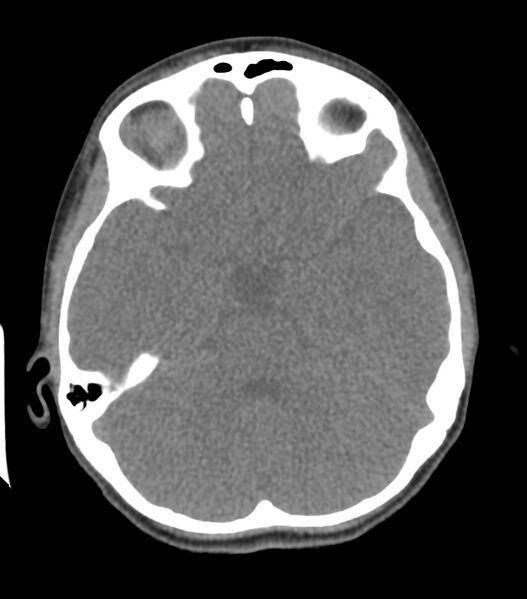 File:Nasoorbitoethmoid fracture (Radiopaedia 90044-107205 Axial 163).jpg
