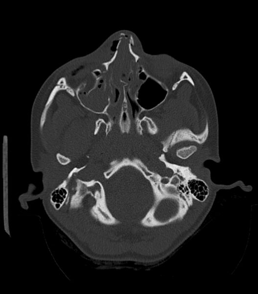 File:Nasoorbitoethmoid fracture (Radiopaedia 90044-107205 Axial bone window 70).jpg
