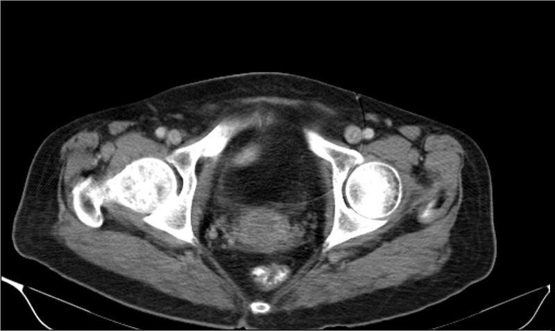 File:Necrotizing pancreatitis (Radiopaedia 20595-20495 A 44).jpg